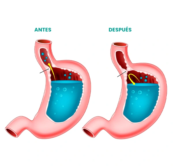 Ilustración comparativa del estómago antes y después de una cirugía antirreflujo. En la imagen de la izquierda ("Antes"), se muestra el contenido gástrico subiendo hacia el esófago, indicando reflujo gastroesofágico. En la imagen de la derecha ("Después"), se observa una válvula fortalecida que evita el ascenso del contenido ácido, representando el resultado tras la intervención quirúrgica