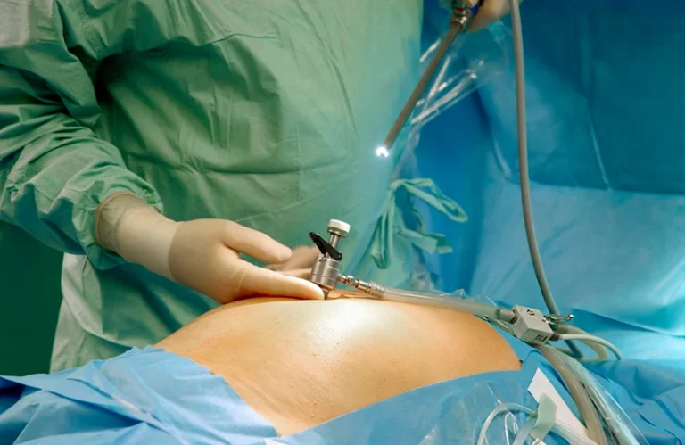 Un cirujano realizando una cirugía laparoscópica en un paciente. La imagen muestra el procedimiento médico mediante el uso de un laparoscopio, con los equipos y el paciente en posición, todo dentro de un quirófano.