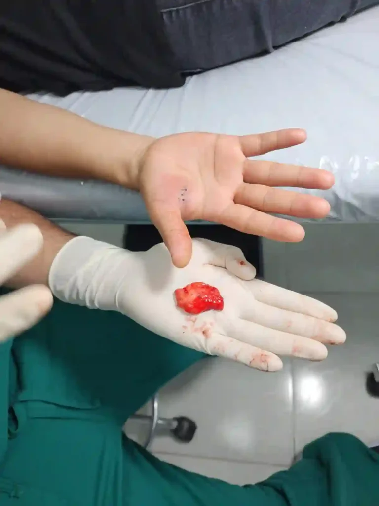 Mano de un paciente con puntos de sutura tras la extirpación de un lipoma en la palma, mientras un profesional médico sostiene la masa extraída con guantes quirúrgicos.