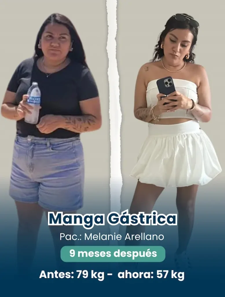 Antes y después de una cirugía bariátrica