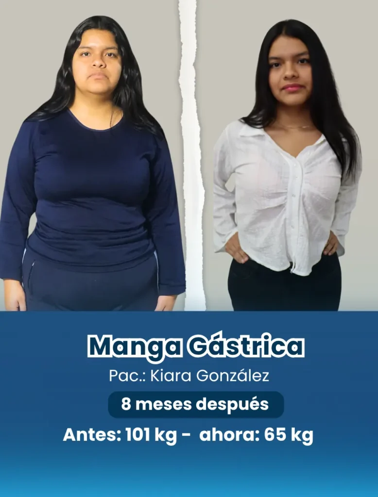 Antes y después de una joven después de su cirugía bariátrica