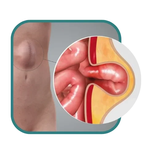 Eventraciones abdominales como Cirugías mayores
