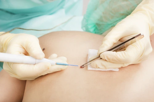 Mujer sometiéndose al proceso de una cirugía menor