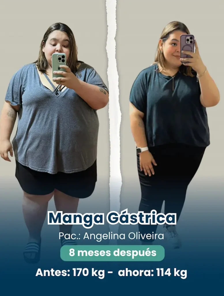antes y despúes de una cirugía con un cirujano bariátrico