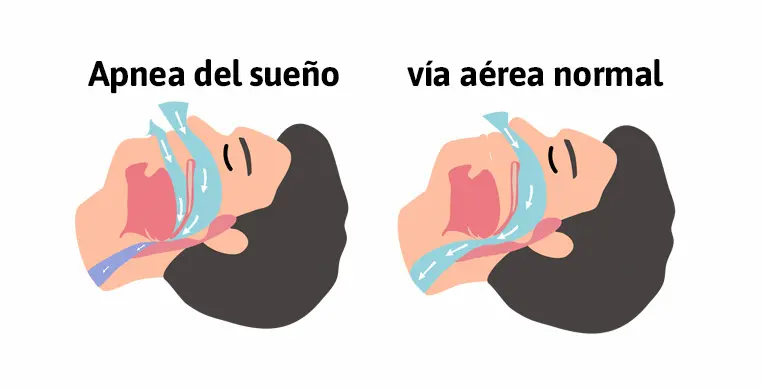 gráfico que explica lo que la apnea del sueño