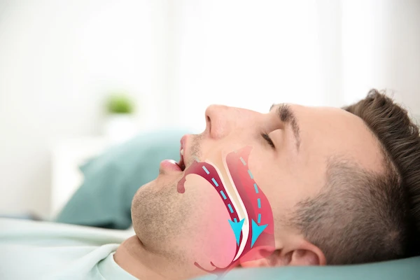 Gráfico de señor durmiendo mientras sufre de apneas de sueño