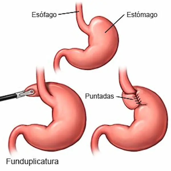 Esquema de funduplicatura de Nissen en cirugía antirreflujo mostrando la corrección del reflujo gastroesofágic